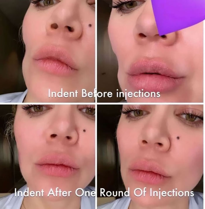 Khloé Kardashian Shares Before-and-After Pics of Facial Injections After Removing Tumor From Cheek Khloé Kardashian Shares Before-and-After Pics of Facial Injections After Removing Tumor From Cheek