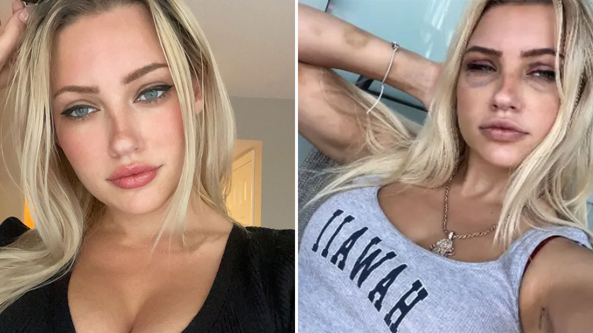 “Psycho” Plastic Surgeon Allegedly Used Ex As Slave, Forcibly Injected Fillers Without Anesthesia