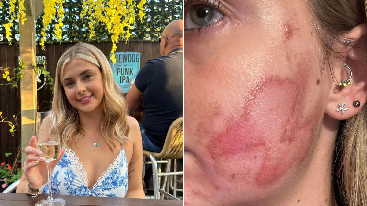 “Horrific”: Woman Suffers Second-Degree Burns After Getting Popular Beauty Procedure