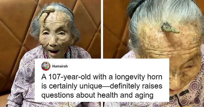 “It’s Too Risky”: 107YO Goes Viral For 4-Inch “Longevity Horn” Growing From Her Forehead