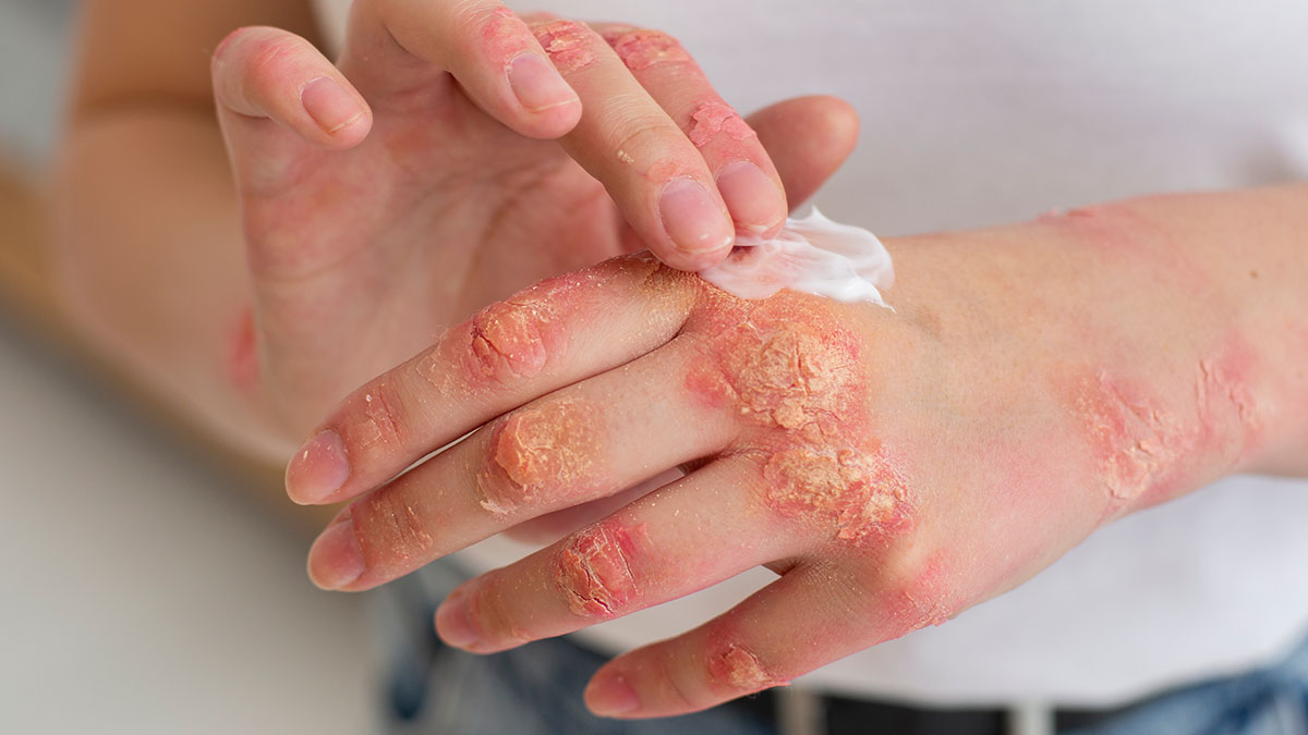 Woman Suspects Hubby Turned On Soft Water To “Test” Her Eczema, Worries About Her Marriage