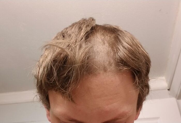 After Fixing My Hair Trimmer, I Forgot To Put The Depth Thing Back On