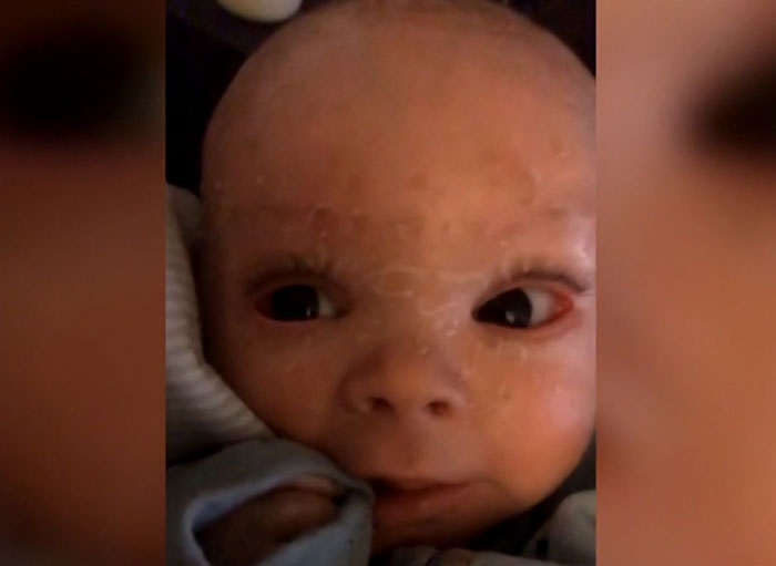 "Absolute Nightmare": 7YO With Rare Condition Sleeps With His Eyes Closed For The First Time "Absolute Nightmare": 7YO With Rare Condition Sleeps With His Eyes Closed For The First Time