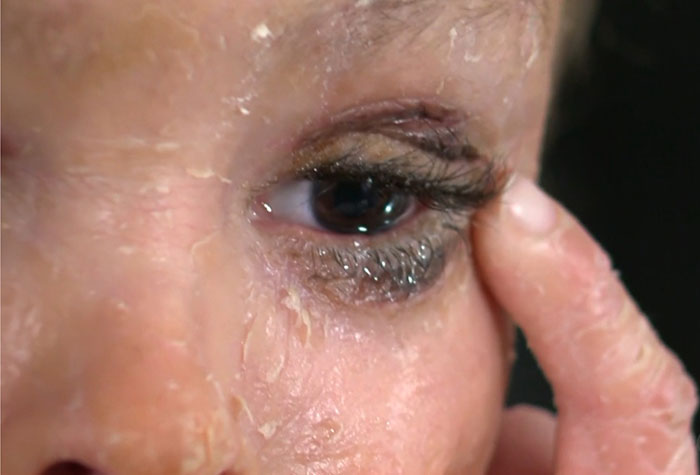 "Absolute Nightmare": 7YO With Rare Condition Sleeps With His Eyes Closed For The First Time "Absolute Nightmare": 7YO With Rare Condition Sleeps With His Eyes Closed For The First Time