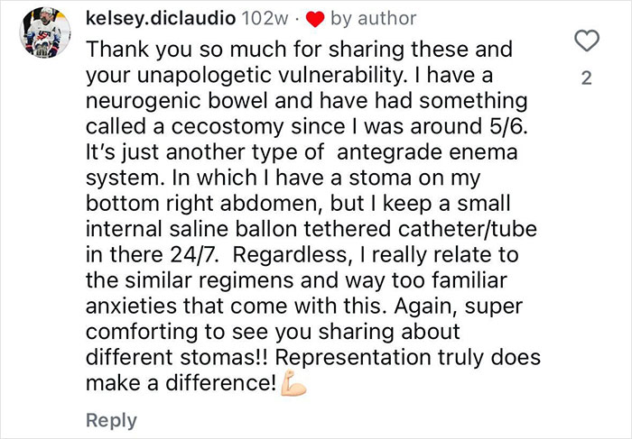 "Ashamed And Embarrassed": Man Without An Anus Reveals His Peculiar Bowel Habits "Ashamed And Embarrassed": Man Without An Anus Reveals His Peculiar Bowel Habits
