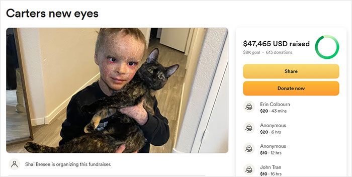 "Absolute Nightmare": 7YO With Rare Condition Sleeps With His Eyes Closed For The First Time "Absolute Nightmare": 7YO With Rare Condition Sleeps With His Eyes Closed For The First Time