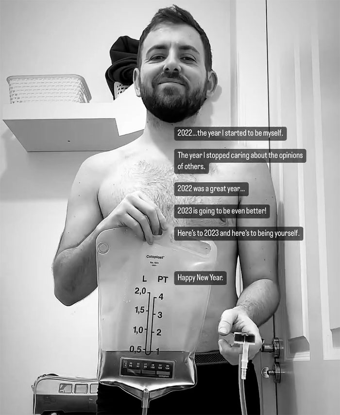 "Ashamed And Embarrassed": Man Without An Anus Reveals His Peculiar Bowel Habits "Ashamed And Embarrassed": Man Without An Anus Reveals His Peculiar Bowel Habits