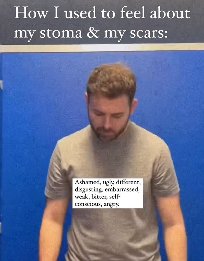 "Ashamed And Embarrassed": Man Without An Anus Reveals His Peculiar Bowel Habits "Ashamed And Embarrassed": Man Without An Anus Reveals His Peculiar Bowel Habits
