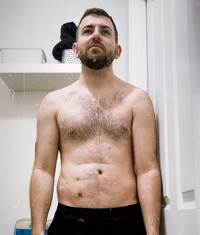 "Ashamed And Embarrassed": Man Without An Anus Reveals His Peculiar Bowel Habits "Ashamed And Embarrassed": Man Without An Anus Reveals His Peculiar Bowel Habits