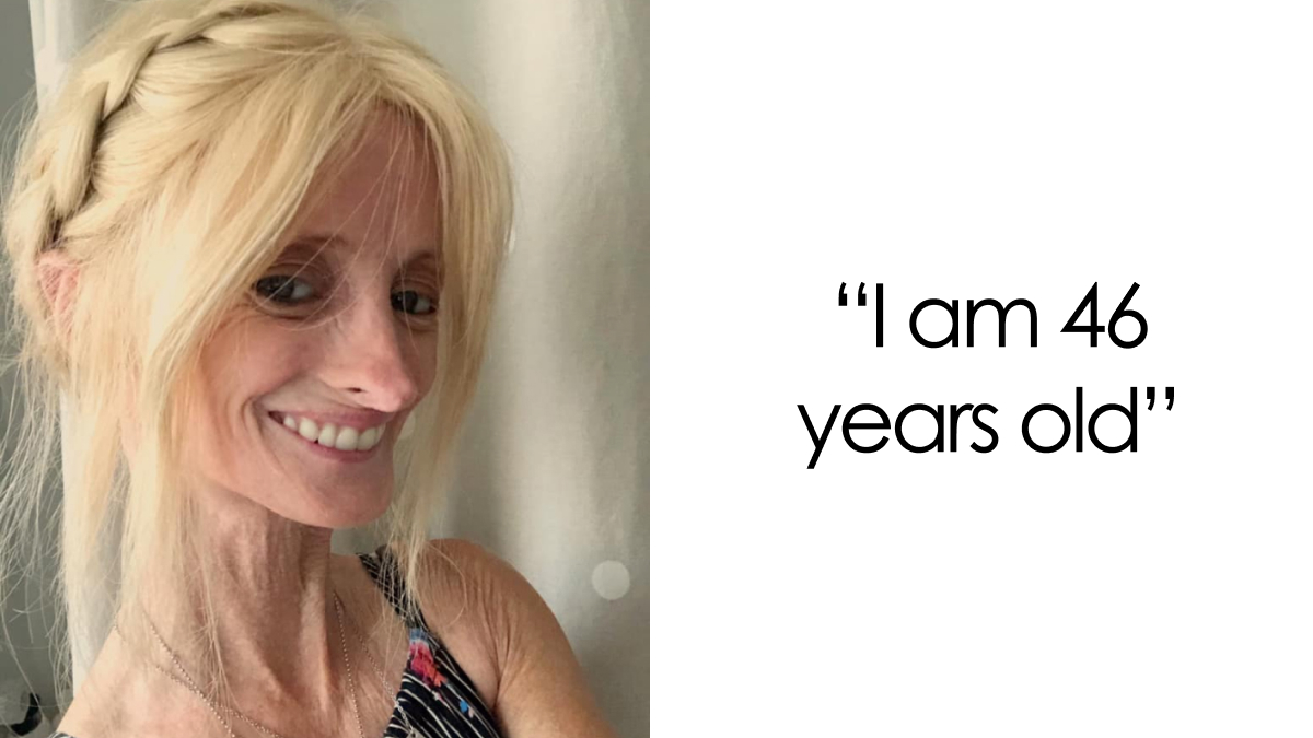 “Right Now Is All We Have”: Woman With Rare ‘Benjamin Button’ Condition Claps Back At Trolls