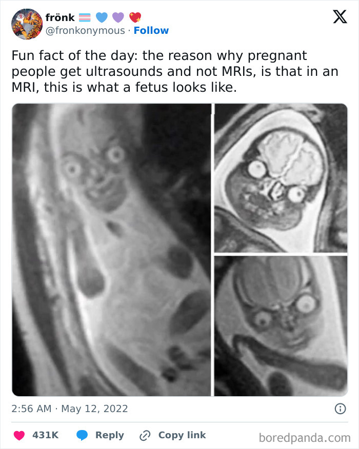 MRI scan humor meme, showing the eerie look of a fetus in an MRI compared to ultrasound, highlighting science humor.