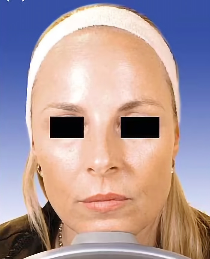 Close-up of a woman's face with black rectangles over her eyes, showing effects of Botox treatment. Close-up of a woman's face with black rectangles over her eyes, showing effects of Botox treatment.