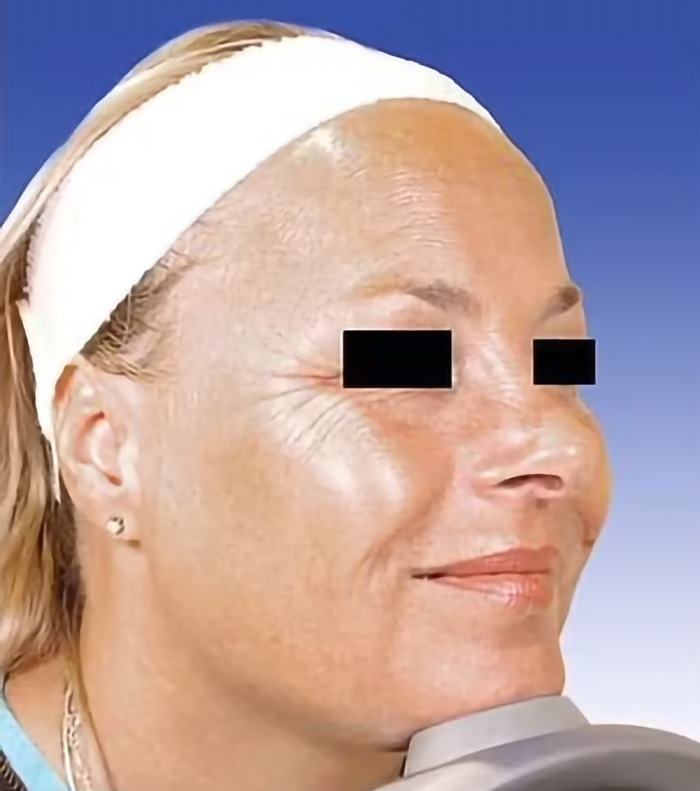 Woman with headband showing natural aging, highlighted as one twin ages naturally compared to Botox use. Woman with headband showing natural aging, highlighted as one twin ages naturally compared to Botox use.