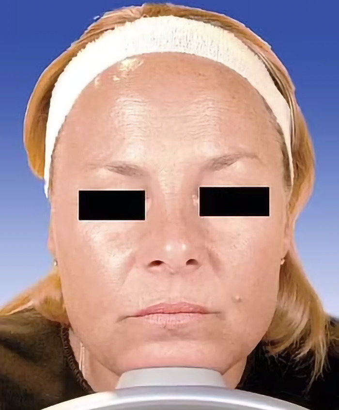 Close-up of a woman's face with a headband, showing natural aging features. Close-up of a woman's face with a headband, showing natural aging features.