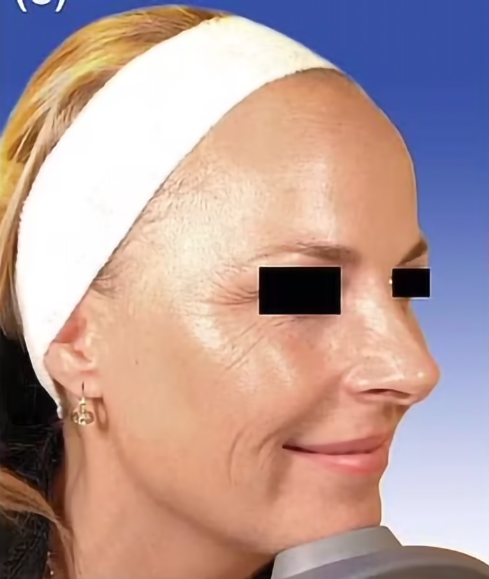 Close-up profile of a twin with natural aging, wearing a headband and earrings, highlighting skin texture differences. Close-up profile of a twin with natural aging, wearing a headband and earrings, highlighting skin texture differences.