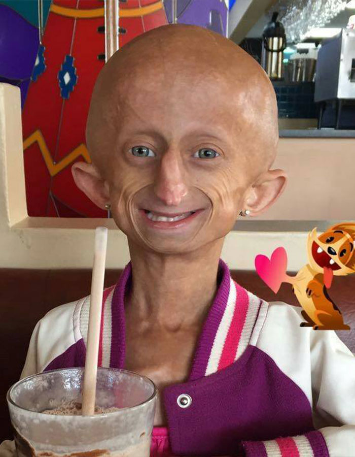 Teen Who Aged 8 Times Faster And Dreamed Of Marrying Passes Away Before Christmas Teen Who Aged 8 Times Faster And Dreamed Of Marrying Passes Away Before Christmas