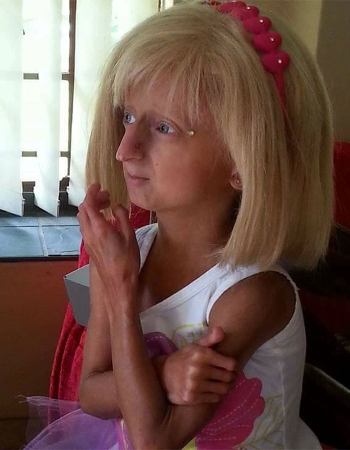 Teen Who Aged 8 Times Faster And Dreamed Of Marrying Passes Away Before Christmas Teen Who Aged 8 Times Faster And Dreamed Of Marrying Passes Away Before Christmas