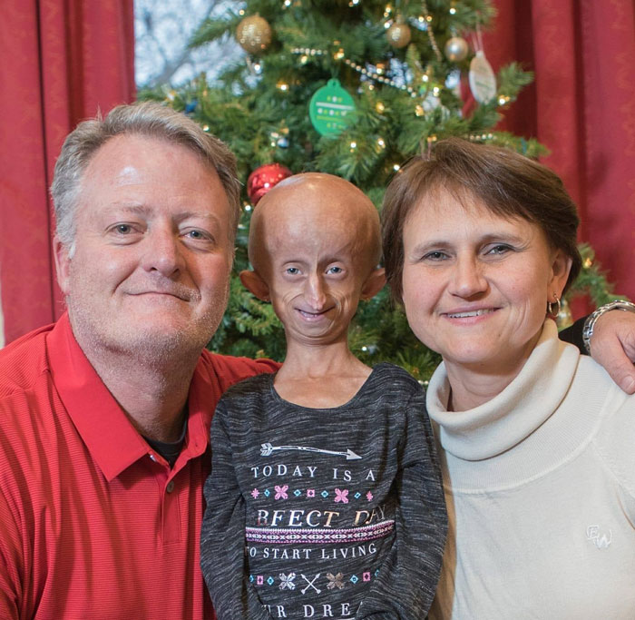 Teen Who Aged 8 Times Faster And Dreamed Of Marrying Passes Away Before Christmas Teen Who Aged 8 Times Faster And Dreamed Of Marrying Passes Away Before Christmas