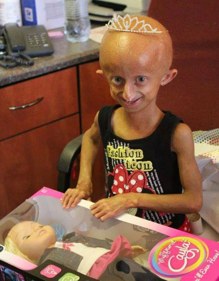 Teen Who Aged 8 Times Faster And Dreamed Of Marrying Passes Away Before Christmas Teen Who Aged 8 Times Faster And Dreamed Of Marrying Passes Away Before Christmas