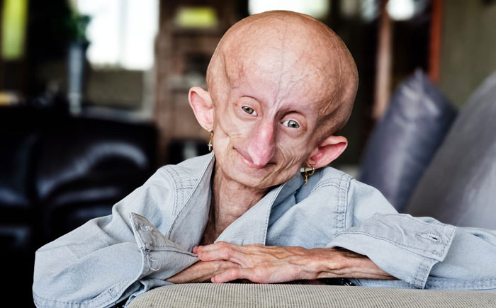 Teen Who Aged 8 Times Faster And Dreamed Of Marrying Passes Away Before Christmas Teen Who Aged 8 Times Faster And Dreamed Of Marrying Passes Away Before Christmas