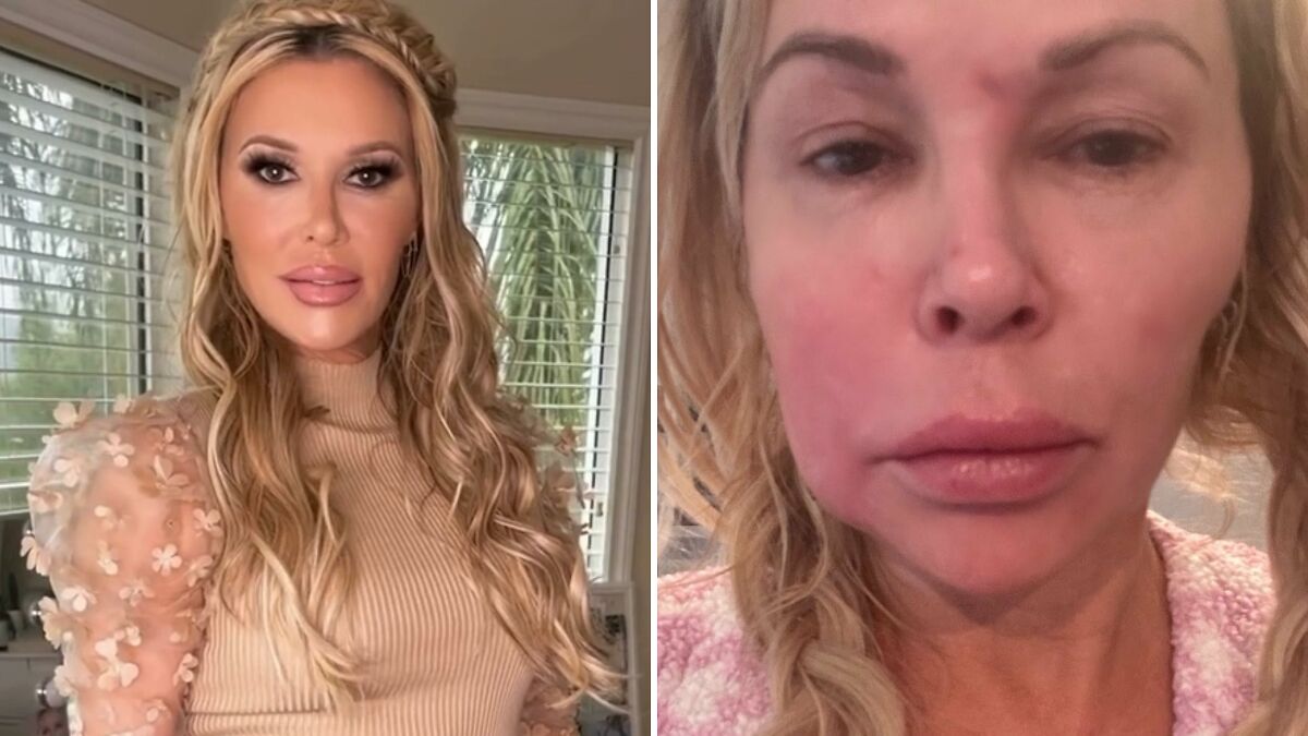 Swollen-Faced Brandi Glanville Says She Can Feel The “Parasite” Having “Babies In [Her] Face”