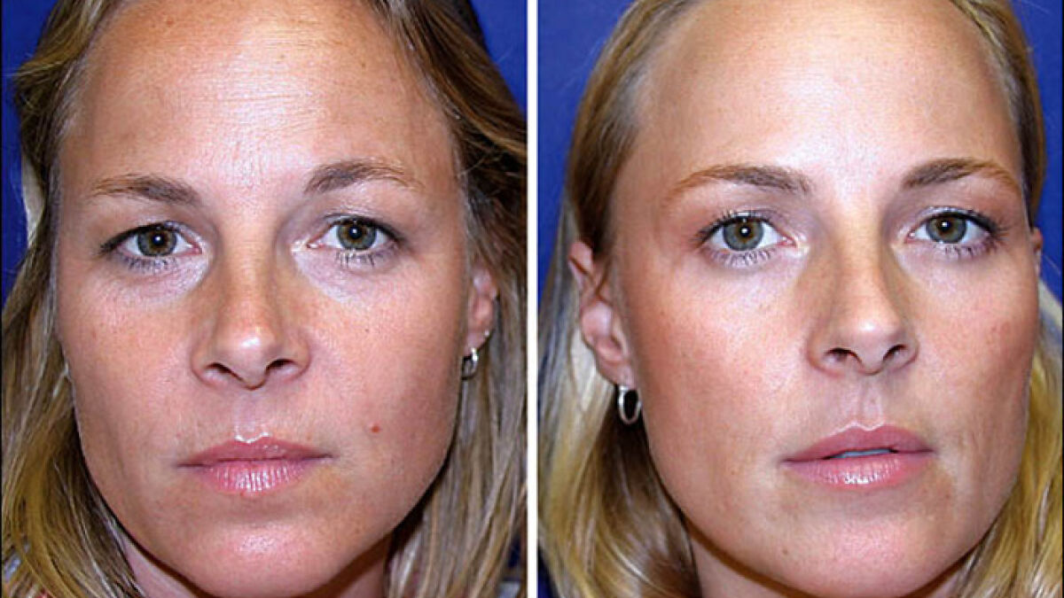 One Twin Ages Naturally, The Other Gets Botox, And Netizens Compare Both