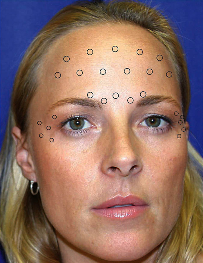 Close-up of a woman with Botox injection points on her face. Close-up of a woman with Botox injection points on her face.