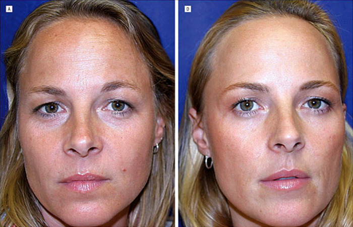 Twin sisters compared: one ages naturally, the other uses Botox, highlighting different aging effects. Twin sisters compared: one ages naturally, the other uses Botox, highlighting different aging effects.