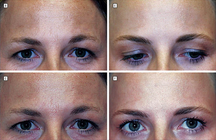 Twin comparison: one ages naturally, other with Botox; netizens react. Twin comparison: one ages naturally, other with Botox; netizens react.