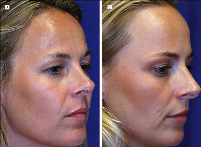 Twin comparison: one aging naturally, the other with Botox treatment. Twin comparison: one aging naturally, the other with Botox treatment.