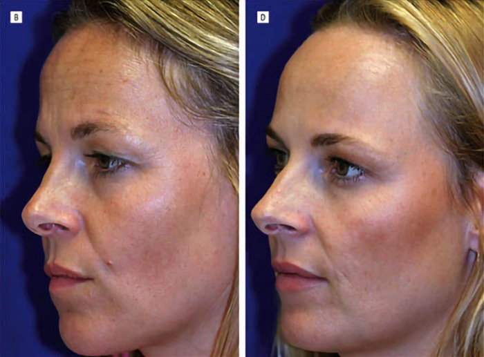 Twin sisters showing natural aging on the left and Botox effects on the right in a side-by-side comparison. Twin sisters showing natural aging on the left and Botox effects on the right in a side-by-side comparison.