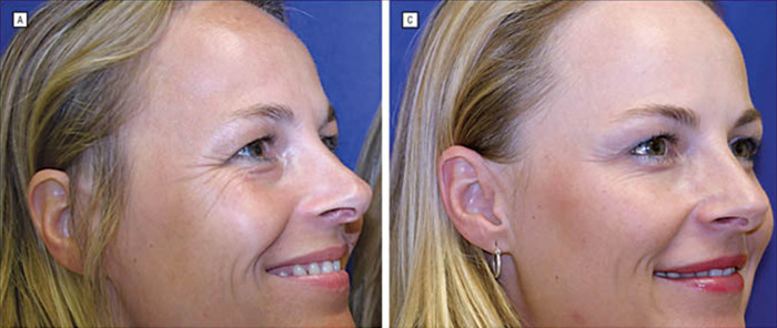 Twin sisters, one showing natural aging, and the other with Botox treatment. Twin sisters, one showing natural aging, and the other with Botox treatment.