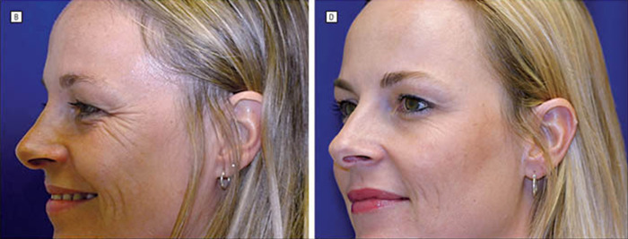 Twin sisters comparison: one with natural aging and the other with Botox, showcasing differences in facial appearance. Twin sisters comparison: one with natural aging and the other with Botox, showcasing differences in facial appearance.