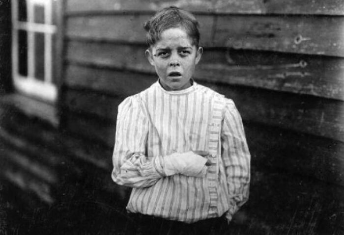 Vintage photo of a young boy with bandaged hand, wearing a striped shirt, standing in front of a wooden wall.