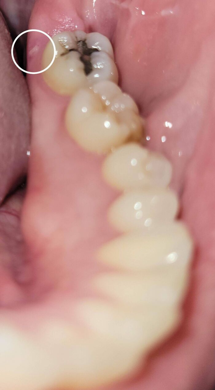 Close-up of lower molars showing dark cavity and circled gum lesion, medical pics