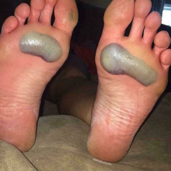 Bluish fluid-filled blisters on both soles, medical pics of unusual plantar blisters and skin discoloration
