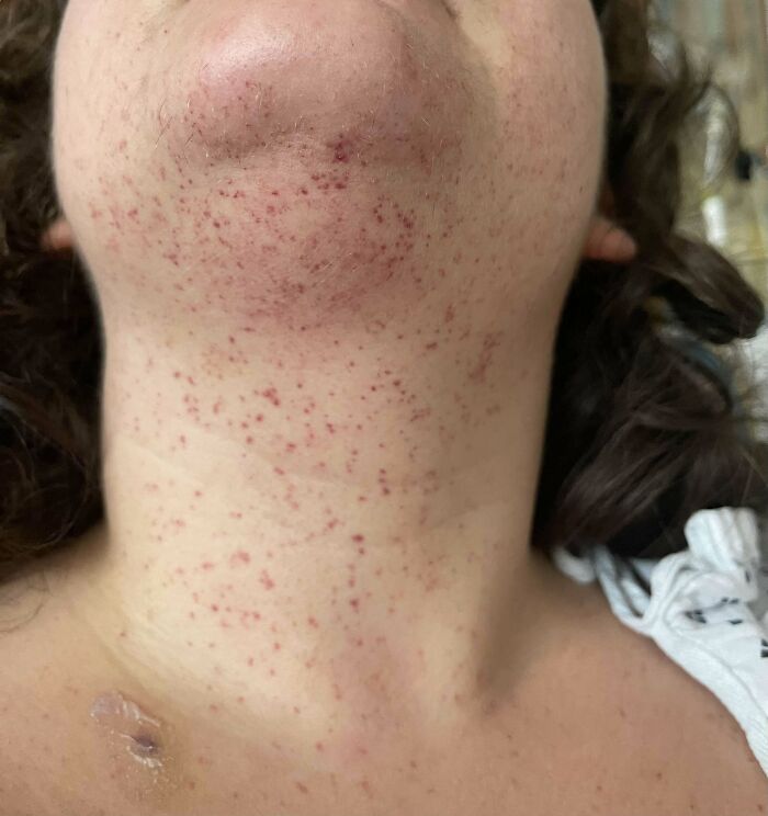 Close-up of chin and neck showing red pinpoint rash and scab, medical pics
