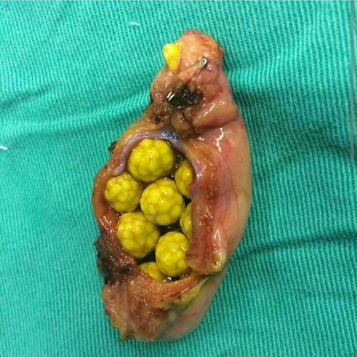 Open surgical specimen showing clustered yellow gallstones inside tissue on green drape, medical pics