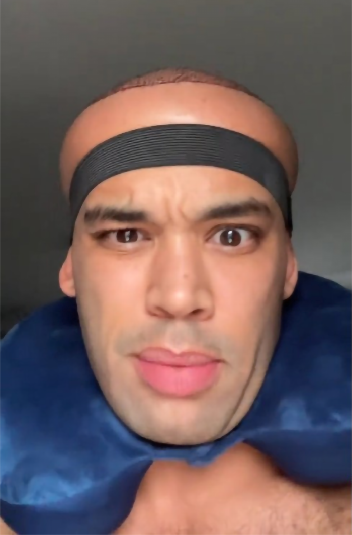 Kanah Flex shows off hair transplant results with a surprised expression, wearing a headband and neck pillow. Kanah Flex shows off hair transplant results with a surprised expression, wearing a headband and neck pillow.