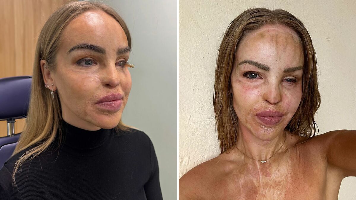 “So Cowardly”: Katie Piper Announces ‘End Of The Road’ Health Update 16 Years After Acid Attack