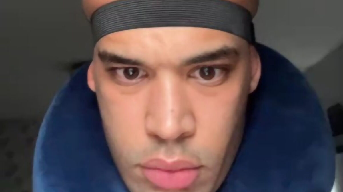 “Looking Crazy”: Man Gets Hair Transplant, Ends Up With Swollen “Megamind” Head