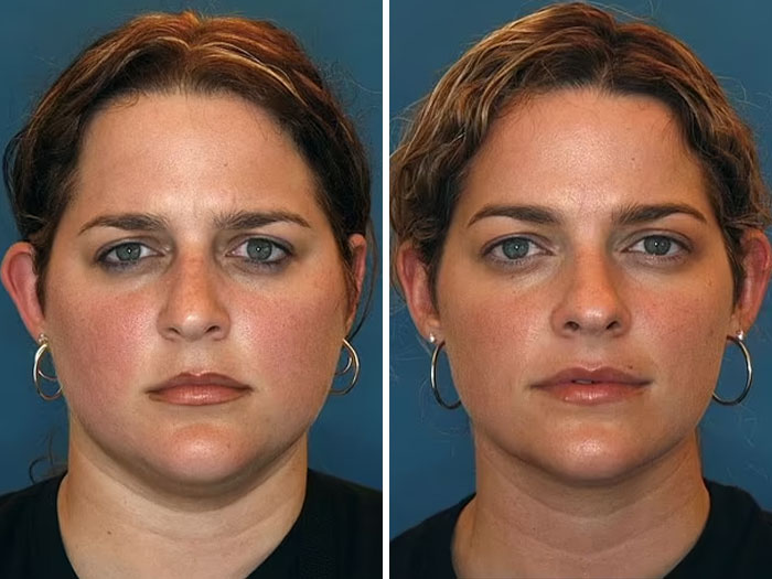 Twins showcasing effects of divorce and bad diet on facial appearance in a viral comparison study. Twins showcasing effects of divorce and bad diet on facial appearance in a viral comparison study.