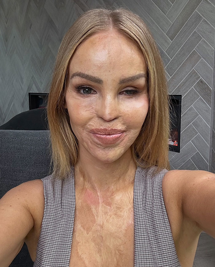 Woman smiling in a checkered top, providing a health update after eye struggle. Woman smiling in a checkered top, providing a health update after eye struggle.