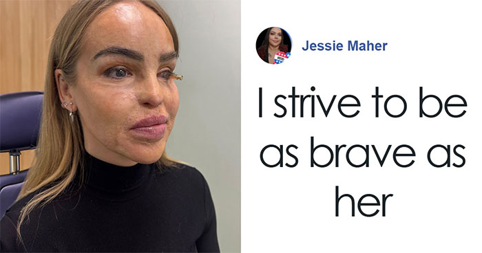“So Cowardly”: Katie Piper Announces ‘End Of The Road’ Health Update 16 Years After Acid Attack