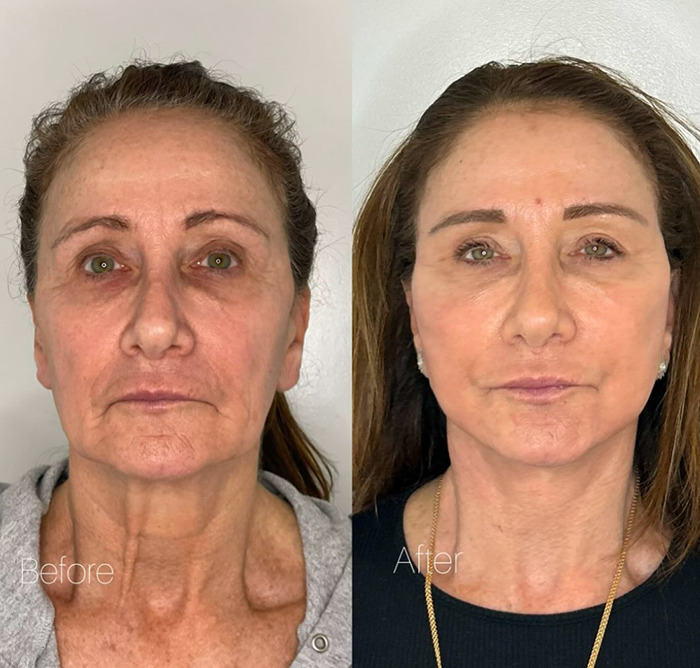 Before and after images showing woman's face treatment results. Before and after images showing woman's face treatment results.