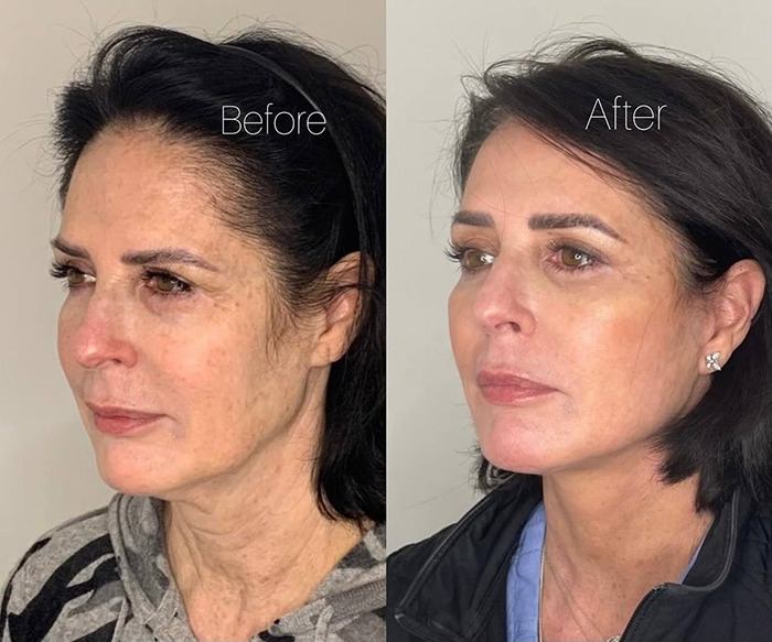 Before and after images of a woman's face treatment. Before and after images of a woman's face treatment.
