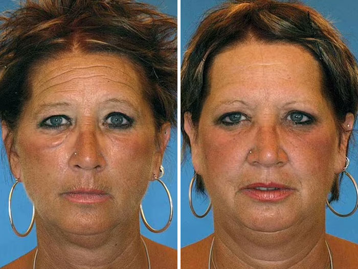 Twin sisters side-by-side in a study highlighting the impact of divorce and poor diet on facial appearance. Twin sisters side-by-side in a study highlighting the impact of divorce and poor diet on facial appearance.