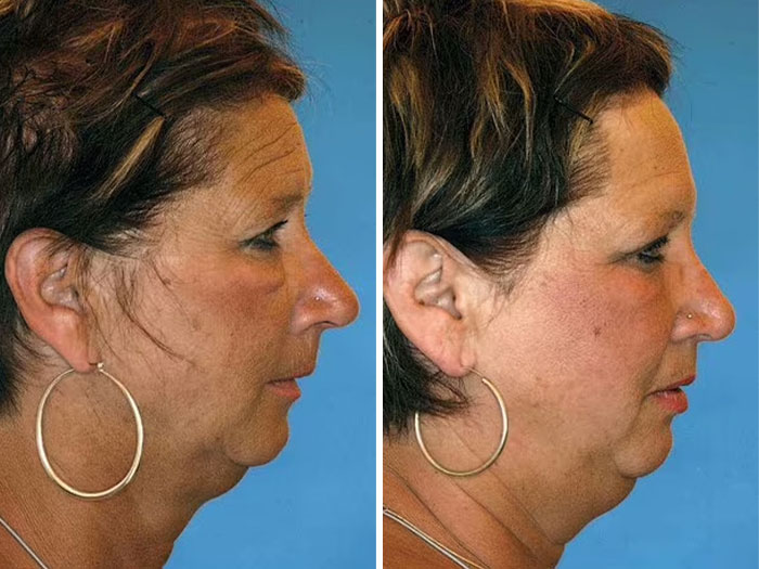 Side-by-side comparison of two women's profiles highlighting the impact of divorce and bad diet on the face. Side-by-side comparison of two women's profiles highlighting the impact of divorce and bad diet on the face.