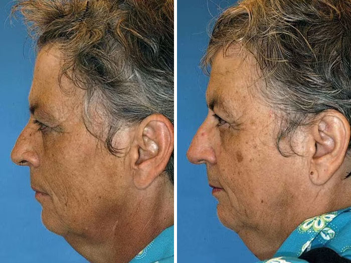 Twin study showing impact of divorce and diet on the face, side-by-side profile comparison with aging effects visible. Twin study showing impact of divorce and diet on the face, side-by-side profile comparison with aging effects visible.