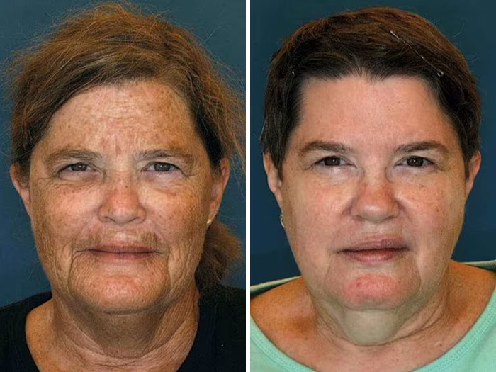 Twins showing facial differences due to divorce and bad diet in viral study. Twins showing facial differences due to divorce and bad diet in viral study.